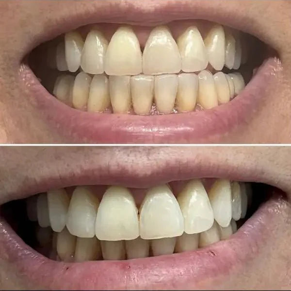 SmileBeam™ Wireless Teeth Whitening Kit