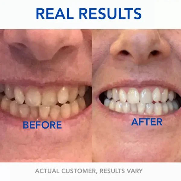 SmileBeam™ Wireless Teeth Whitening Kit